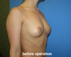 plastic-surgery-breast-augmentation